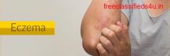 Eczema Treatment in Dwarka