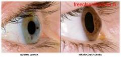 Keratoconus Eye Treatment & Surgery