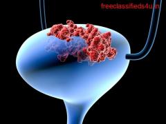 BCG Bladder Cancer Treatment Cost in Coimbatore-Bladder Cancer Treatment Coimbatore