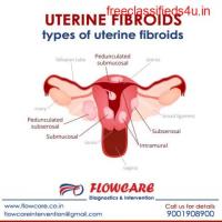Uterine Fibroids Treatment - Uterine Fibroids Embolization, Symptoms & Causes