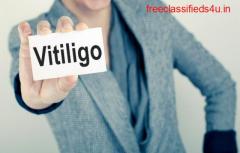 What are the signs and symptoms indicate to be have vitiligo?