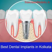 Dental Implant In Kolkata  Best Dental Implant In Kolkata Dental Implant Treatment In Kolkata
