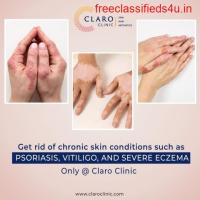 Psoriasis Treatment | Dermatologist in Mumbai | Claro Clinic