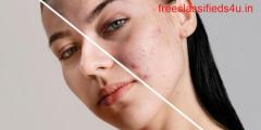 Get Smooth And Clear Skin And With Acne Scar Treatment in Hyderabad