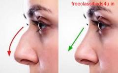Unveiling the cost of Rhinoplasty in Kolkata - Practical Guide 