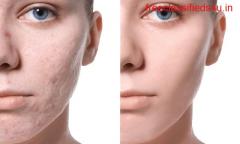 What To Do After Acne Scar Removal Treatment In Kolkata