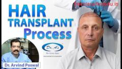 Best Cost Effective Hair Transplant Clinic In Delhi- Dr. A's Clinic