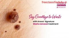 Warts Removal treatment with advanced technology at Anoos